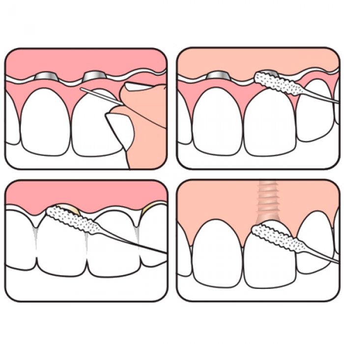  Зубная нить TePe Dental Bridge/ImplantFloss, 5 шт, купить суперфлосс TePe Минск, зубная нить ТеПе Гомель, шведские товары для зубов Беларусь, флосс для имплантов с доставкой РБ, стоматологическая аптека CrossVill
