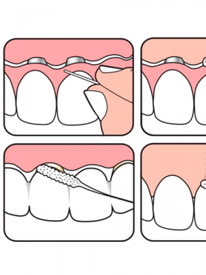  Зубная нить TePe Dental Bridge/ImplantFloss, 5 шт, купить суперфлосс TePe Минск, зубная нить ТеПе Гомель, шведские товары для зубов Беларусь, флосс для имплантов с доставкой РБ, стоматологическая аптека CrossVill